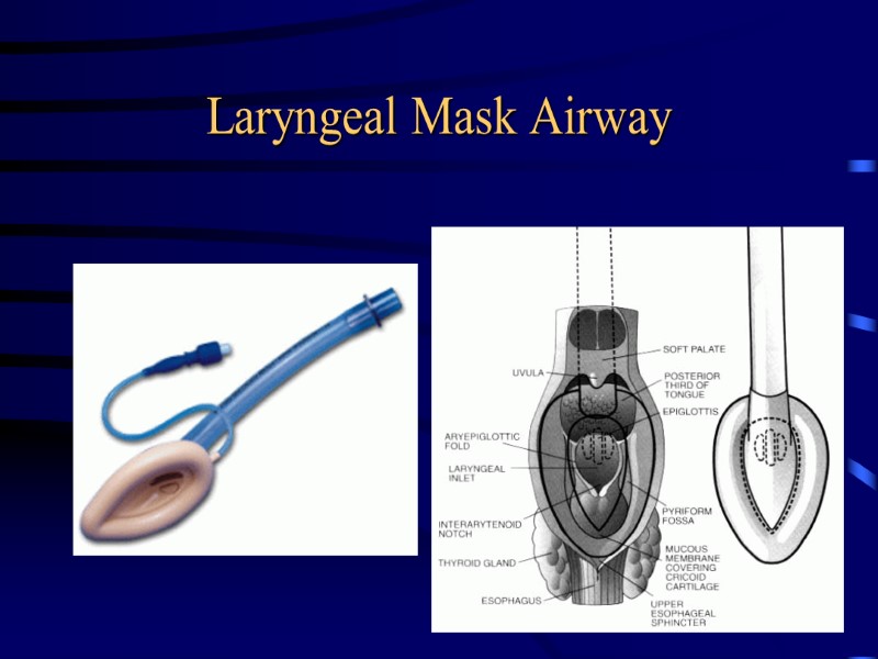 Laryngeal Mask Airway